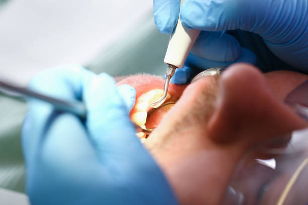 Best Emergency Gum Treatment in Sacramento, CA
