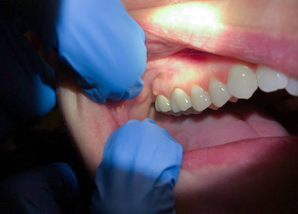 Best Emergency Dental Care for Broken or Chipped Teeth in Sacramento, CA