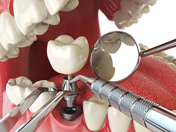 Best Emergency Root Canal Treatment in Sacramento, CA